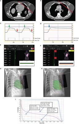 Deep Inspiration Breath Hold: Techniques and Advantages for Cardiac Sparing During Breast Cancer Irradiation
